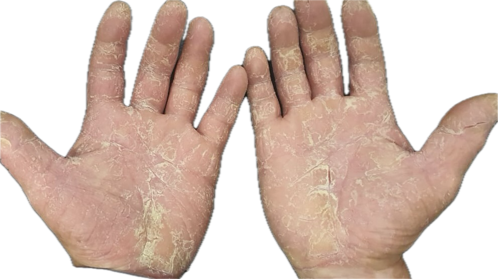 Psoriasis